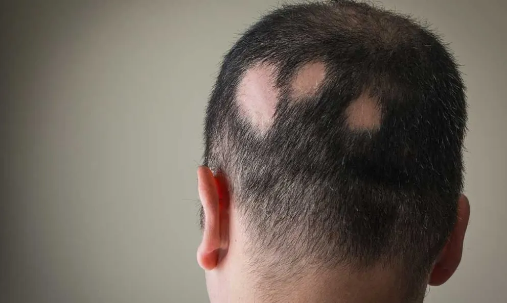 alopecia-what-you-need-to-know