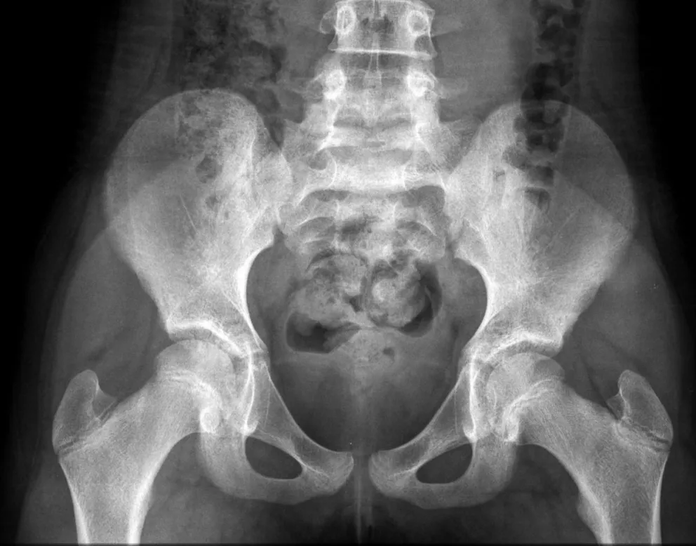 Los rayos X de una niña saludable de 10 años.