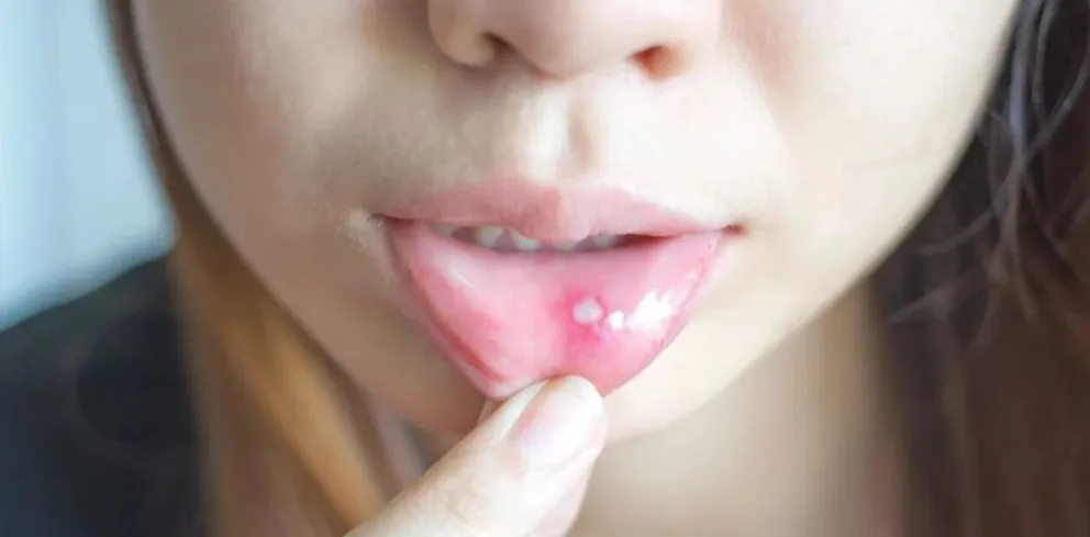 Las molestas llagas en la lengua o la boca puede tener alivio y desaparecer antes.