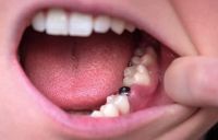 ANMAT prohibió unos implantes dentales: qué marca no hay que usar