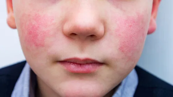 パルボウイルス：子供たちを脅かすこの病気とは何か、そしてどのように現れるのか